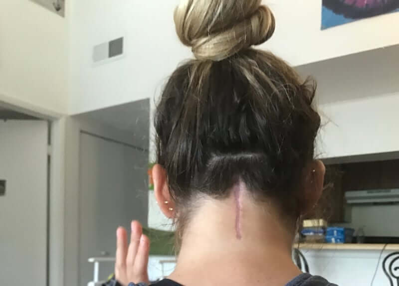 neck scar